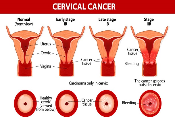 Women Cancer; Cervical Cancer: Cervical Cancer in Nigeria and Africa; Cervical Cancer Age Standardized Rate; What is Cancer of the Cervix?; Cancer of the cervix
