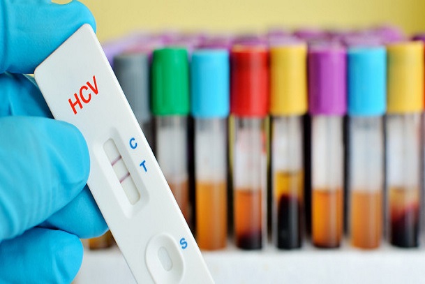 HCV, hepatitis c, management of hepatitis c, diagnosing HCV, treating HCV