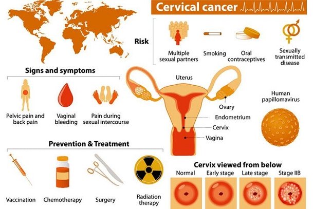 Cervical Cancer Symptoms; Is cervical cancer real?; Signs and symptoms of cervical cancer