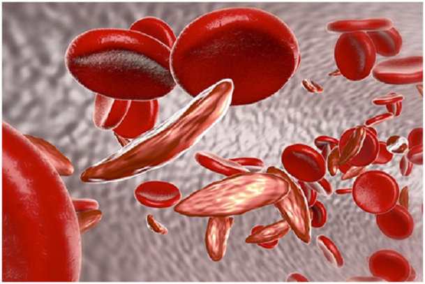 Interesting Sickle Cell Disease (SCD) Facts You Didn’t know Before