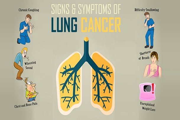 How lung cancer presents, clinical features of lung cancer, lung cancer, signs and symptoms of lung cancers