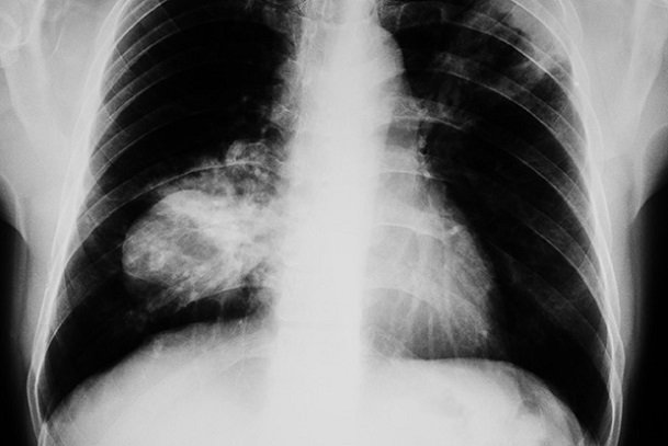 Lung cancer; introduction to lung cancer; lung cancer in Nigeria