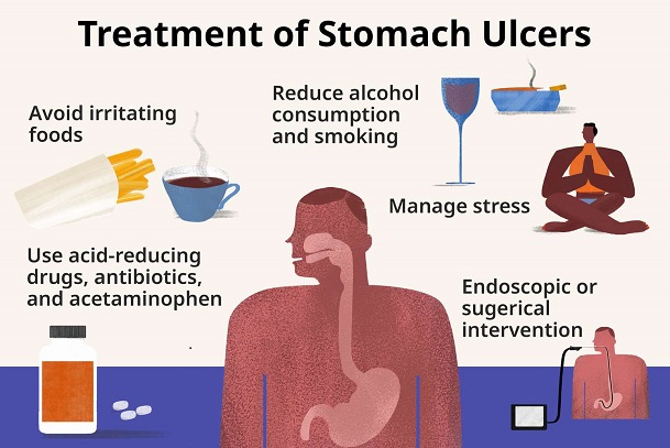 managing stomach ulcer; treatment of stomach; diagnosing stomach ulcer; ulcerstomach ulcer; duodenum; gastric acid; gastric ulcer; peptic ulcer