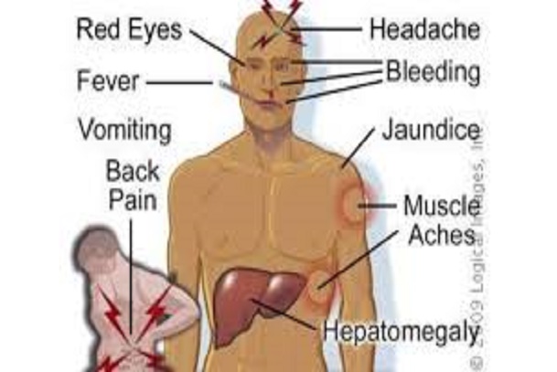 Yellow fever presentation; Signs and symptoms of yellow fever; how yellow fever presents
