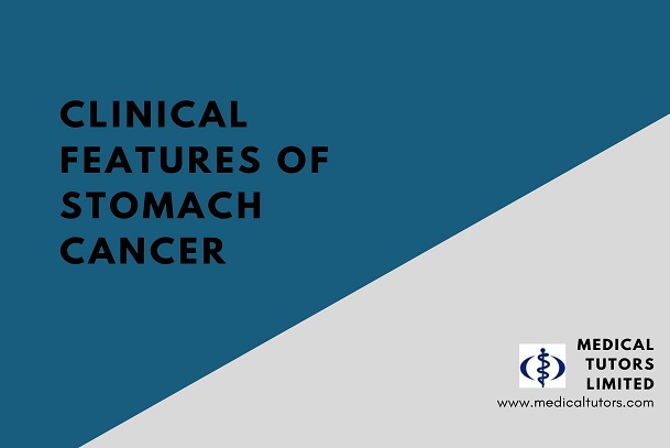 Signs and Symptoms of Stomach Cancer; Clinical features of stomach cancer; how can I recognise stomach cancer; what causes stomach cancer; risk factors associated with stomach cancer